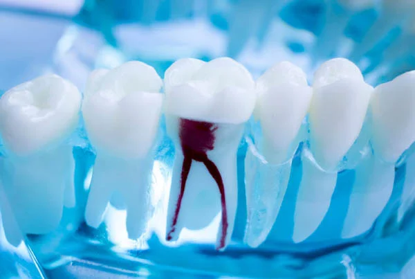 Root Canal Treatment