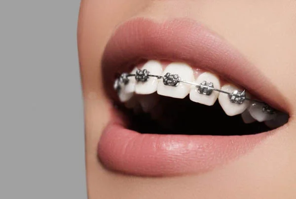 Orthodontic Treatment