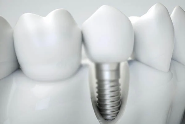 Dental Implants