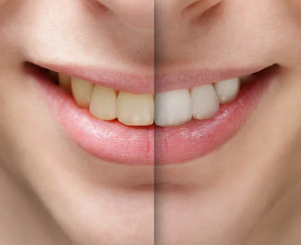 Teeth Whitening
